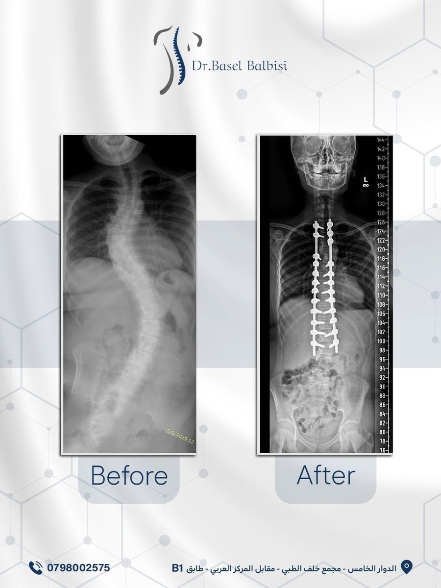 Before & after scoliosis correction post for Dr. Basel Balbisi